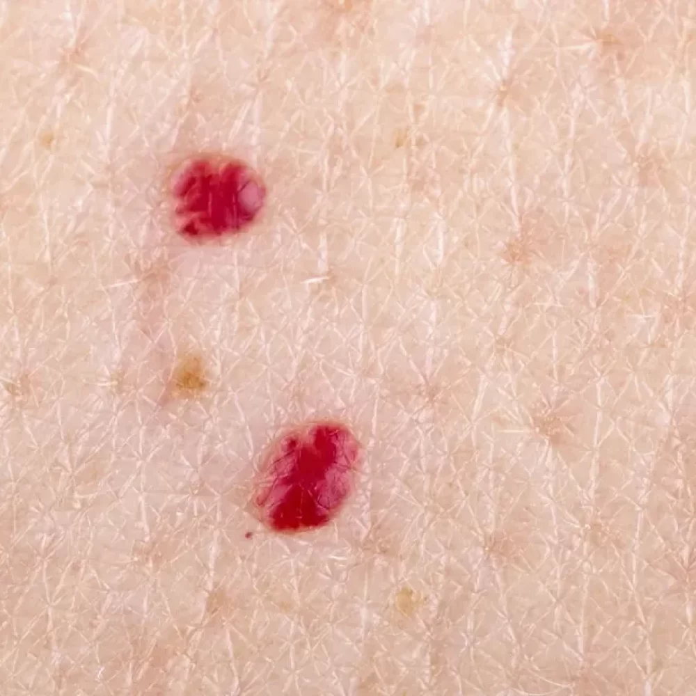 Close-up-photo-of-cherry-angioma-on-human-skin-body1-1